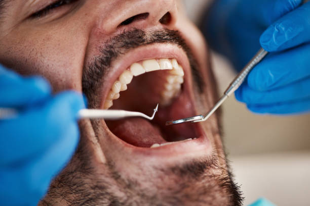 Best Emergency Wisdom Teeth Removal in Faison, NC